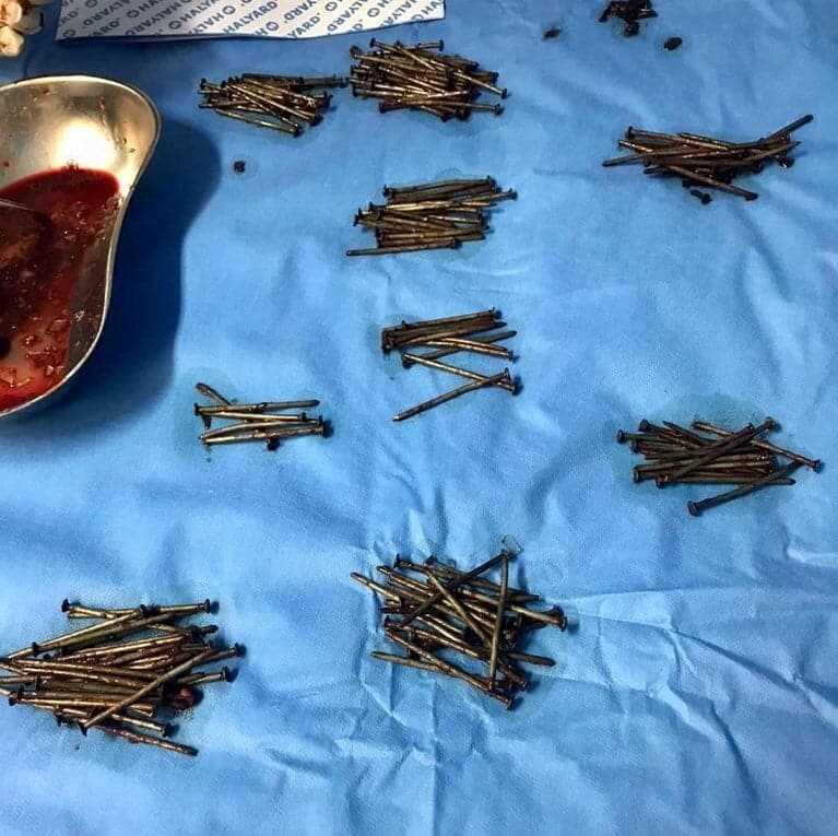 Doctors remove 230 nails from a man's stomach in Jeddah