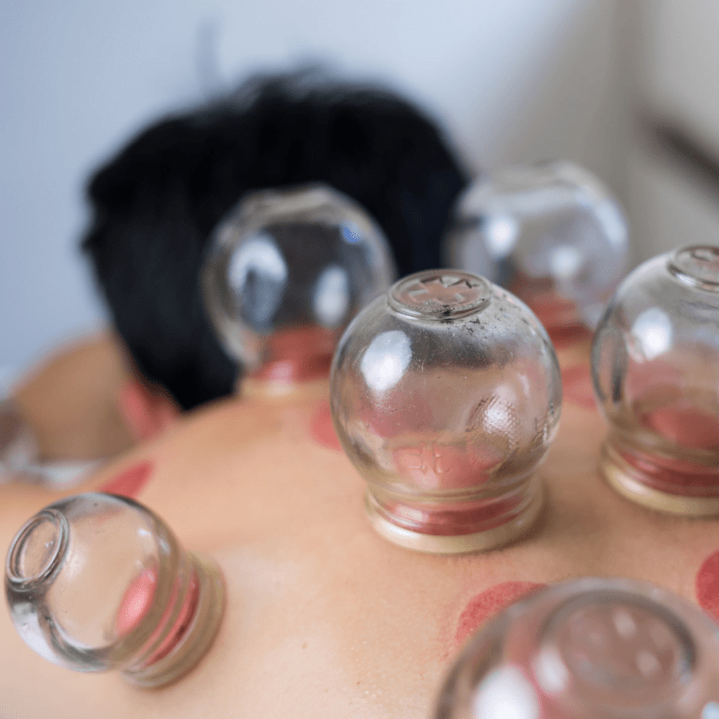 hijama cupping therapy